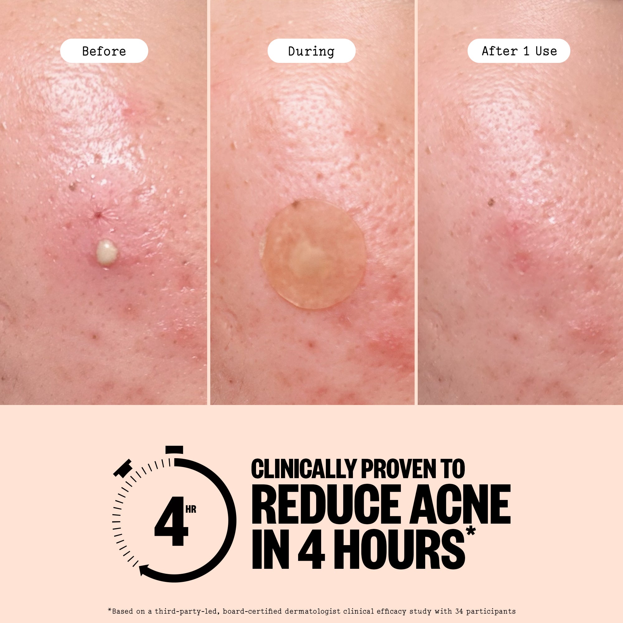 Acne Treatment 20 Dots